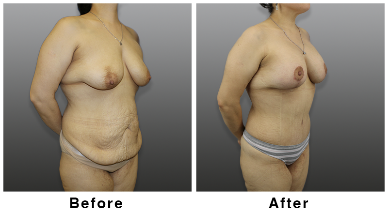 Webb Plastic Surgery result — Paradise Valley, AZ