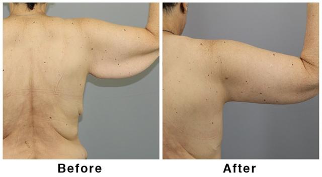 Arm Lift result at Webb Plastic Surgery in Paradise Valley, AZ