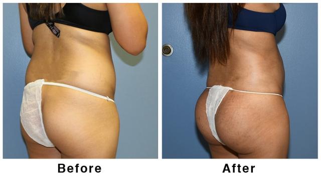 Brazilian Butt Lift result at Webb Plastic Surgery in Paradise Valley, AZ