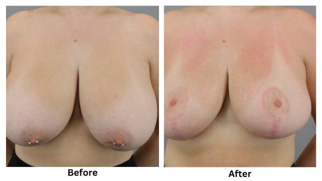 Breast Reduction result at Webb Plastic Surgery in Paradise Valley, AZ