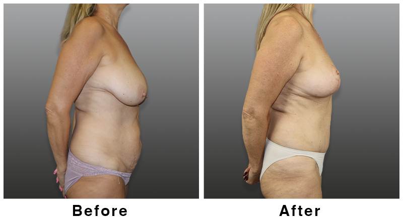 Webb Plastic Surgery result — Paradise Valley, AZ