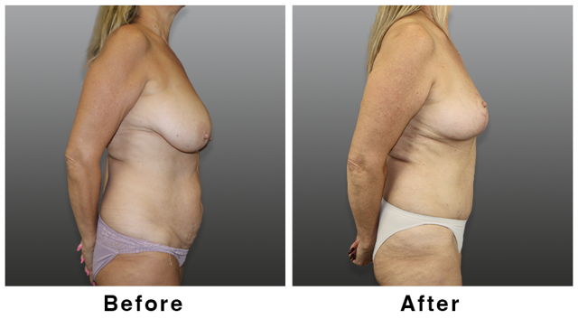 Breast Lift result at Webb Plastic Surgery in Paradise Valley, AZ