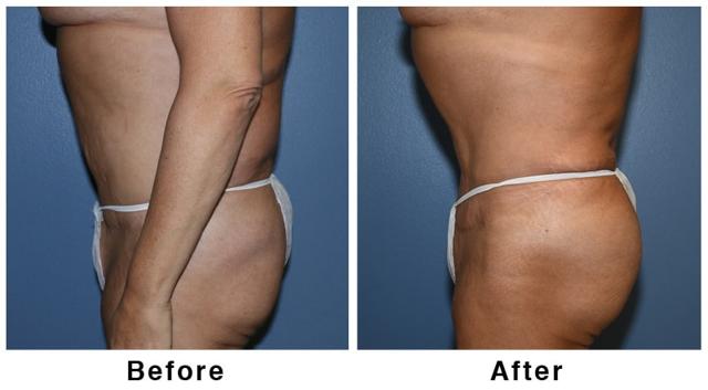 Brazilian Butt Lift result at Webb Plastic Surgery in Paradise Valley, AZ