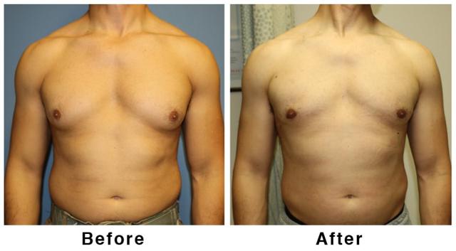 Gynecomastia Surgery result at Webb Plastic Surgery in Paradise Valley, AZ