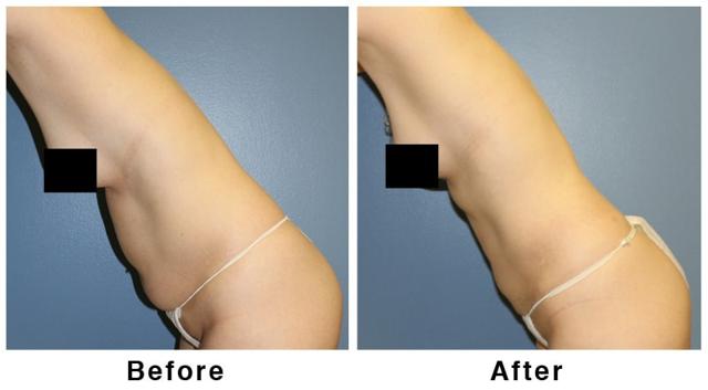 Liposuction result at Webb Plastic Surgery in Paradise Valley, AZ