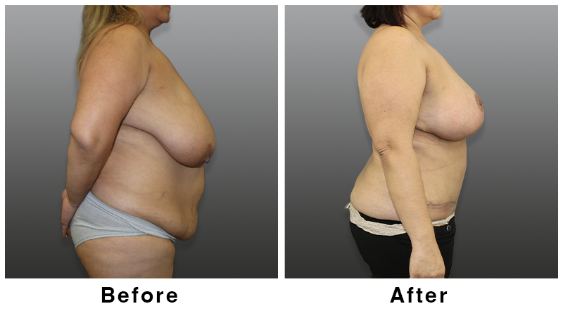Webb Plastic Surgery result — Paradise Valley, AZ