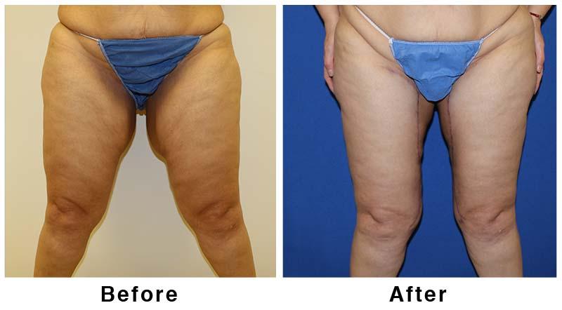 Webb Plastic Surgery result — Paradise Valley, AZ