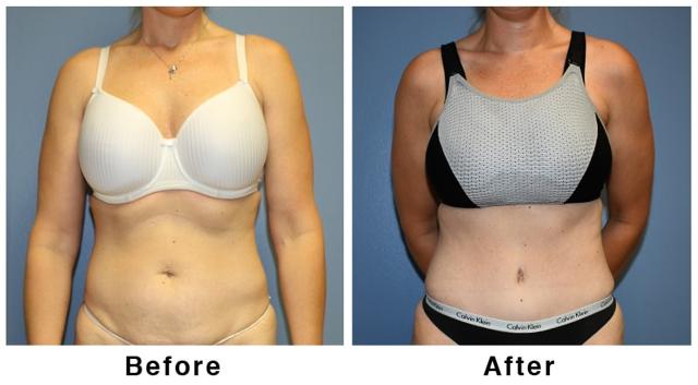 Mini Tummy Tuck result at Webb Plastic Surgery in Paradise Valley, AZ