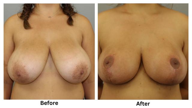 Breast Reduction result at Webb Plastic Surgery in Paradise Valley, AZ
