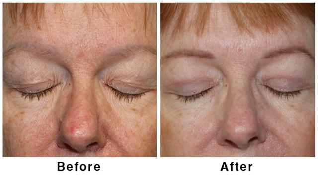 Blepharoplasty result at Webb Plastic Surgery in Paradise Valley, AZ