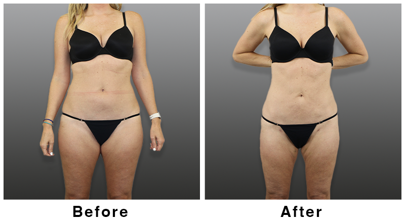 Webb Plastic Surgery liposuction result — Paradise Valley, AZ