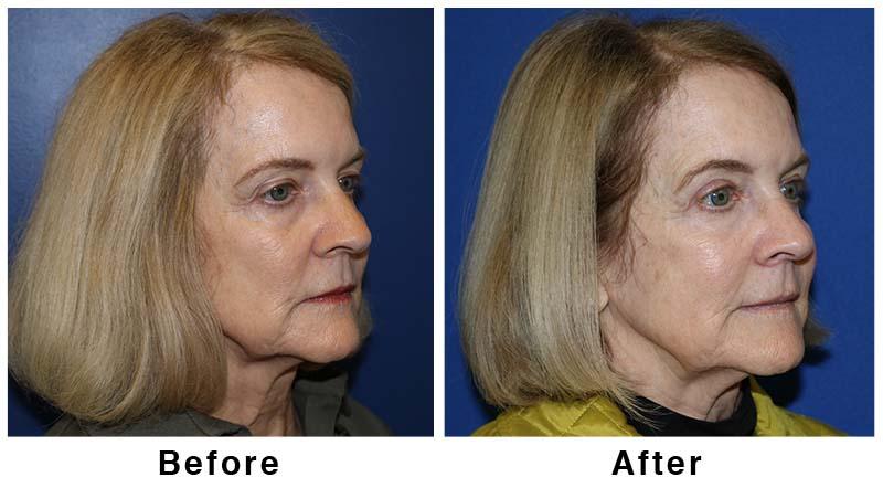 Webb Plastic Surgery result — Paradise Valley, AZ