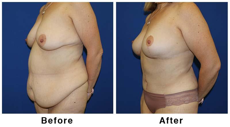 Webb Plastic Surgery mommy makeover result — Paradise Valley, AZ