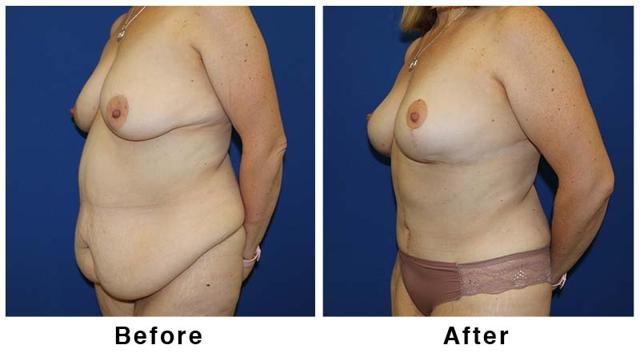 Mommy Makeover result at Webb Plastic Surgery in Paradise Valley, AZ