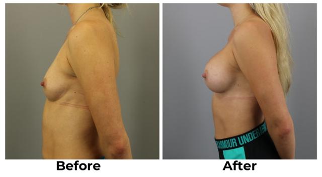 Breast Augmentation result at Webb Plastic Surgery in Paradise Valley, AZ