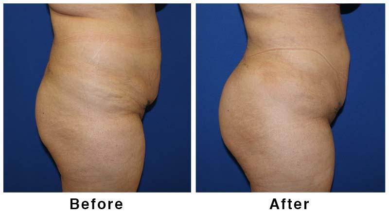 Webb Plastic Surgery result — Paradise Valley, AZ