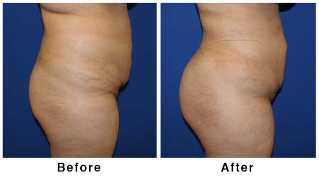Brazilian Butt Lift result at Webb Plastic Surgery in Paradise Valley, AZ
