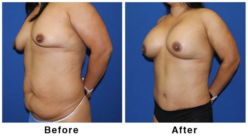 Webb Plastic Surgery mommy makeover result — Paradise Valley, AZ
