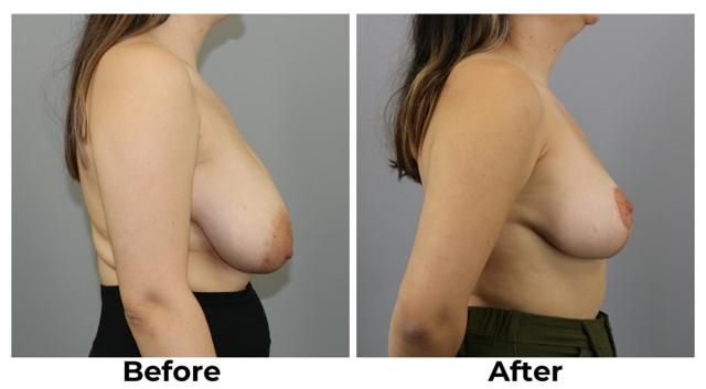 Breast Reduction result at Webb Plastic Surgery in Paradise Valley, AZ