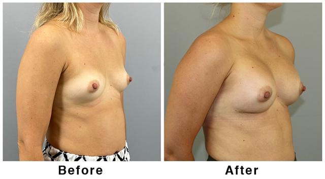 Breast Augmentation result at Webb Plastic Surgery in Paradise Valley, AZ