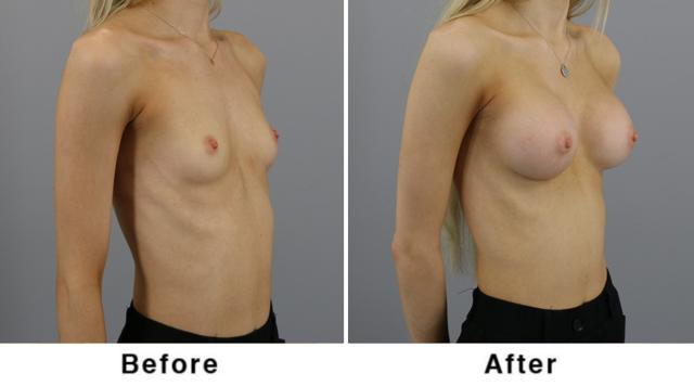 Breast Augmentation result at Webb Plastic Surgery in Paradise Valley, AZ