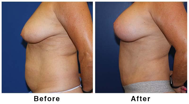 Webb Plastic Surgery mommy makeover result — Paradise Valley, AZ
