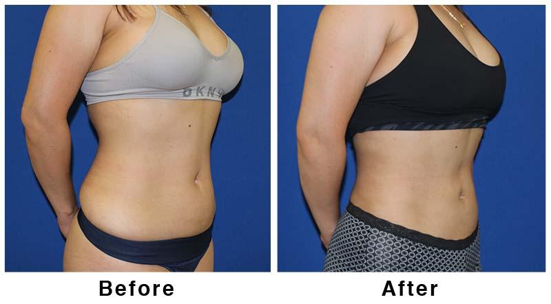 Webb Plastic Surgery liposuction result — Paradise Valley, AZ