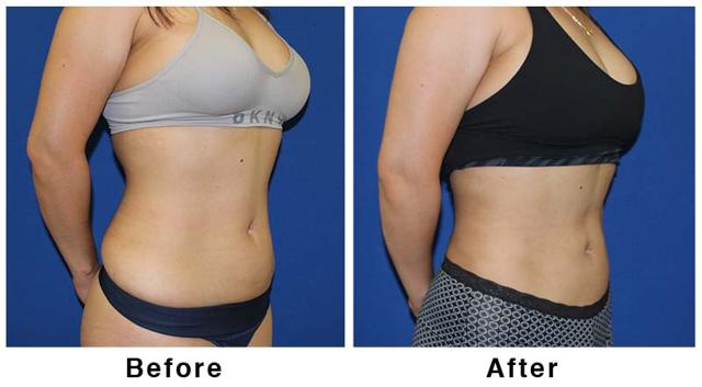 Liposuction result at Webb Plastic Surgery in Paradise Valley, AZ