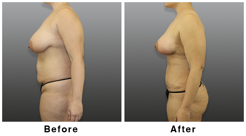 Webb Plastic Surgery result — Paradise Valley, AZ