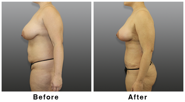 Mini Tummy Tuck result at Webb Plastic Surgery in Paradise Valley, AZ