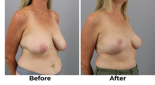 Breast Reduction result at Webb Plastic Surgery in Paradise Valley, AZ