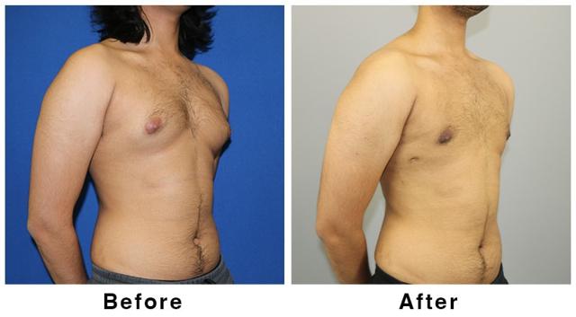 Gynecomastia Surgery result at Webb Plastic Surgery in Paradise Valley, AZ