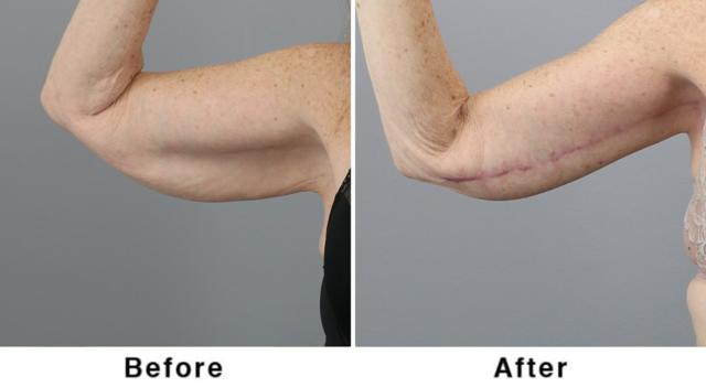 Arm Lift result at Webb Plastic Surgery in Paradise Valley, AZ
