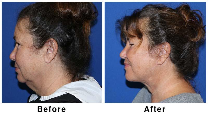 Webb Plastic Surgery result — Paradise Valley, AZ