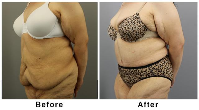 Mini Tummy Tuck result at Webb Plastic Surgery in Paradise Valley, AZ