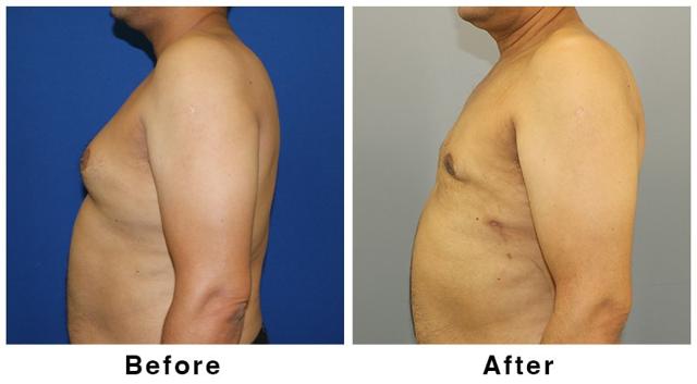 Gynecomastia Surgery result at Webb Plastic Surgery in Paradise Valley, AZ