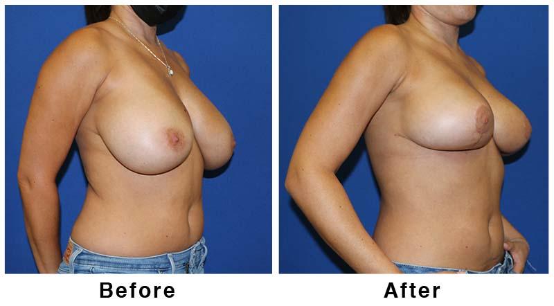 Webb Plastic Surgery breast lift result — Paradise Valley, AZ