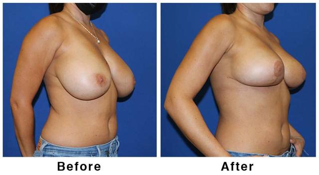Breast Lift result at Webb Plastic Surgery in Paradise Valley, AZ