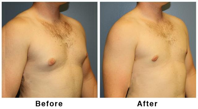 Gynecomastia Surgery result at Webb Plastic Surgery in Paradise Valley, AZ
