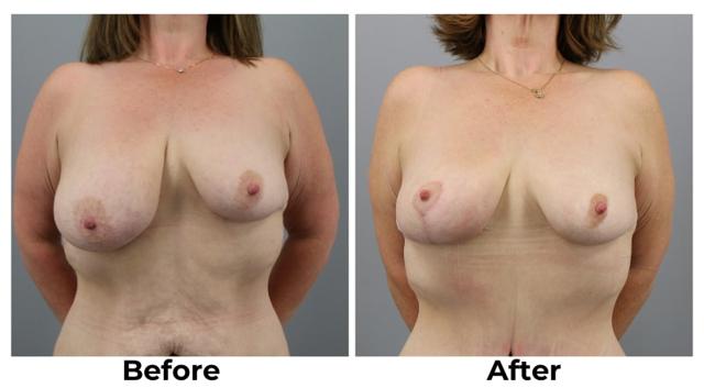 Breast Reduction result at Webb Plastic Surgery in Paradise Valley, AZ