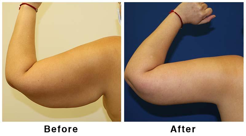 Webb Plastic Surgery result — Paradise Valley, AZ