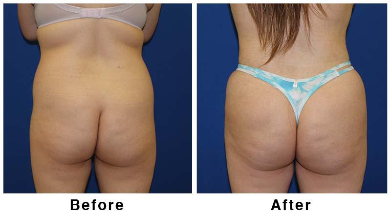 Webb Plastic Surgery result — Paradise Valley, AZ