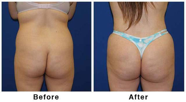 Brazilian Butt Lift result at Webb Plastic Surgery in Paradise Valley, AZ