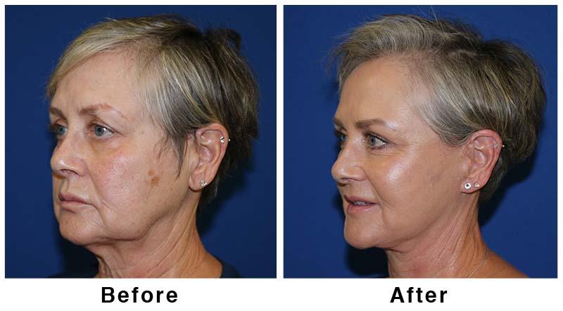 Webb Plastic Surgery result — Paradise Valley, AZ