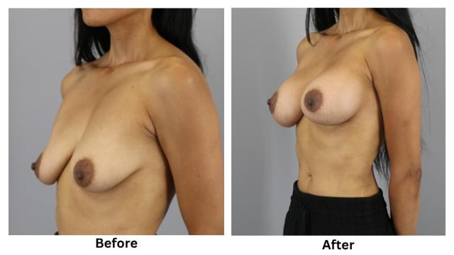 Breast Augmentation result at Webb Plastic Surgery in Paradise Valley, AZ
