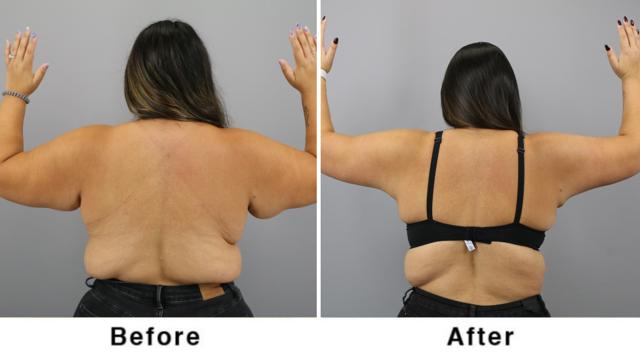Arm Lift result at Webb Plastic Surgery in Paradise Valley, AZ