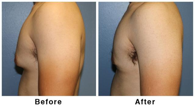 Gynecomastia Surgery result at Webb Plastic Surgery in Paradise Valley, AZ