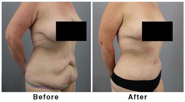 Mini Tummy Tuck result at Webb Plastic Surgery in Paradise Valley, AZ