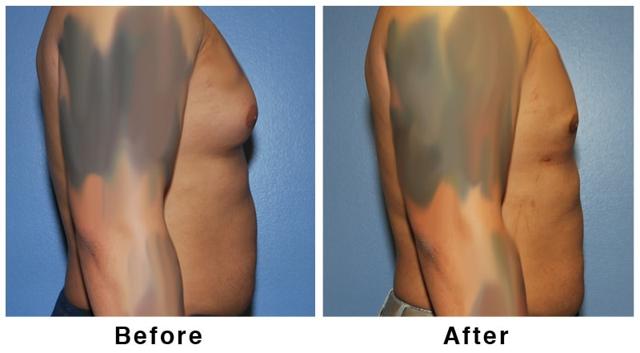 Gynecomastia Surgery result at Webb Plastic Surgery in Paradise Valley, AZ
