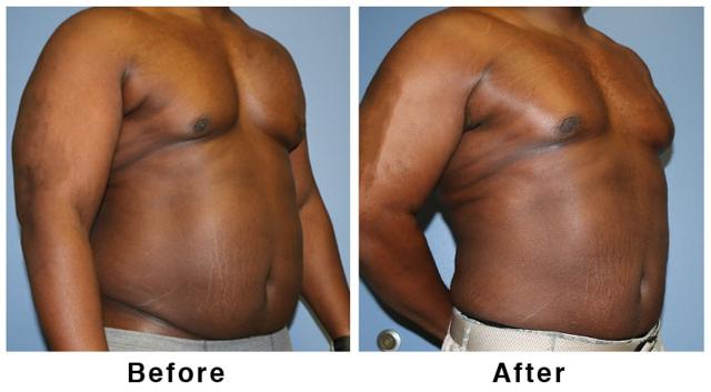 Brazilian Butt Lift result at Webb Plastic Surgery in Paradise Valley, AZ